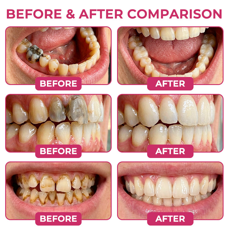 Natravor® DenPerm Cavity-Repair Natural Enamel Filling Gel