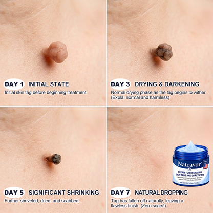 👑Natravor® 7-𝐃𝐚𝐲 𝐒𝐤𝐢𝐧 𝐓𝐚𝐠 & 𝐒𝐩𝐨𝐭 𝐄𝐫𝐚𝐬𝐞𝐫 𝐂𝐫𝐞𝐚𝐦 (Zero Pain, Zero 𝐒𝐜𝐚𝐫𝐬 Formula) 💎