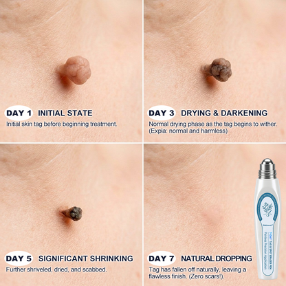 👑𝐎𝐟𝐟𝐢𝐜𝐢𝐚𝐥 𝐁𝐫𝐚𝐧𝐝 𝐒𝐭𝐨𝐫𝐞 |✅👩‍⚕️Natravor® 7-𝐷𝑎𝑦 𝗧𝐚𝐠 & 𝗦𝗽𝐨𝐭 𝐄𝐫𝒂𝒔𝒆𝒓(Zero Pain, Zero 𝐒𝐜𝐚𝒓𝒔 Rollerball)e